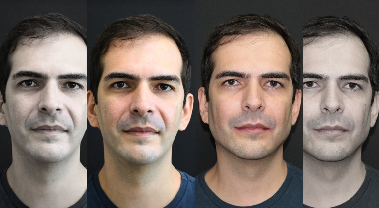 Próteses Faciais