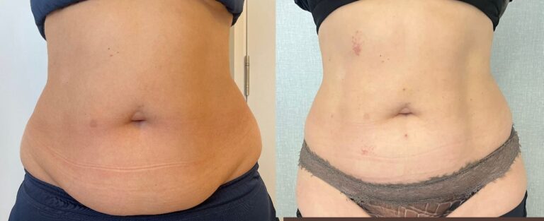 Tratamento de Gordura Localizada