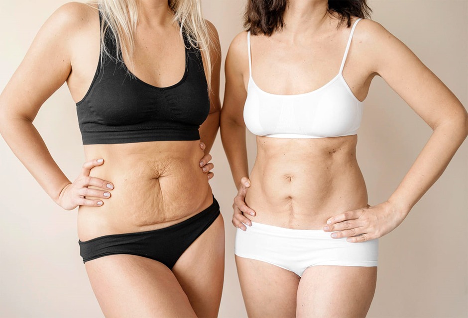 Mommy Makeover
